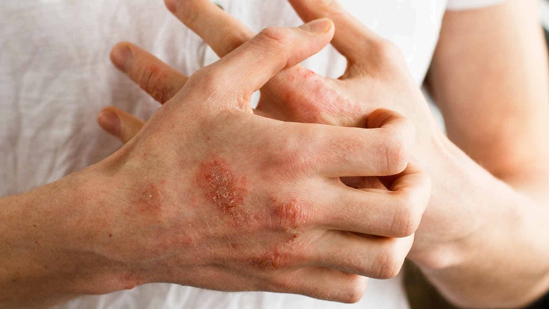 Аллергический дерматит: симптомы и лечение