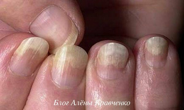 Грибковые заболевания ногтей ног и рук