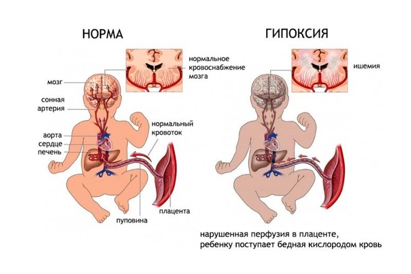 Гипоксия плода - симптомы и последствия для ребенка – на бэби.ру!