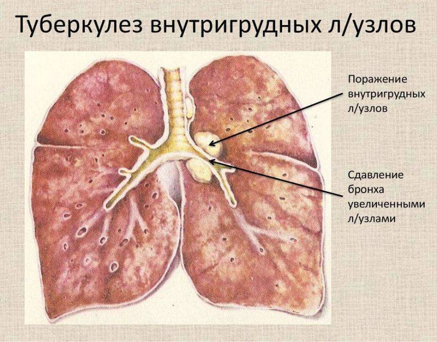 Туберкулез внутригрудных лимфатических узлов презентация