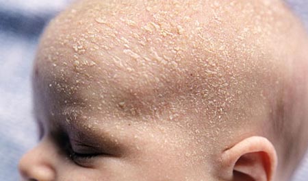 У новорожденного шелушится кожа на теле. причины и  лечение шелушения кожи у новорожденных