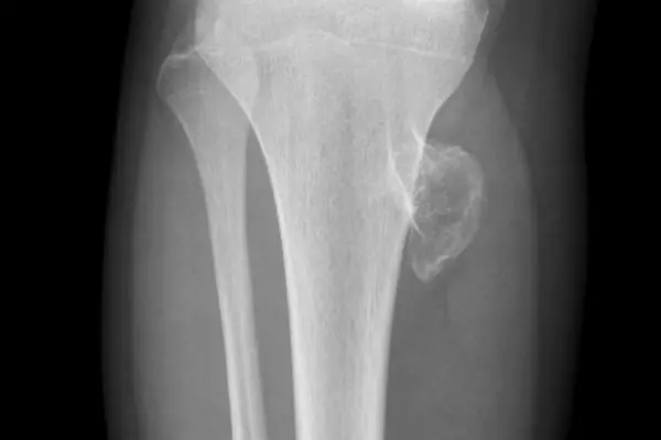 Экзостоз костно хрящевой коленного сустава десны бедренной и плечевой кости