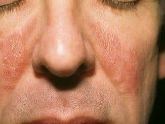 Bepanthol Sensiderm Eczema крем для атопического дерматита, экземы, сухости, аллергических реакций кожи 50 г