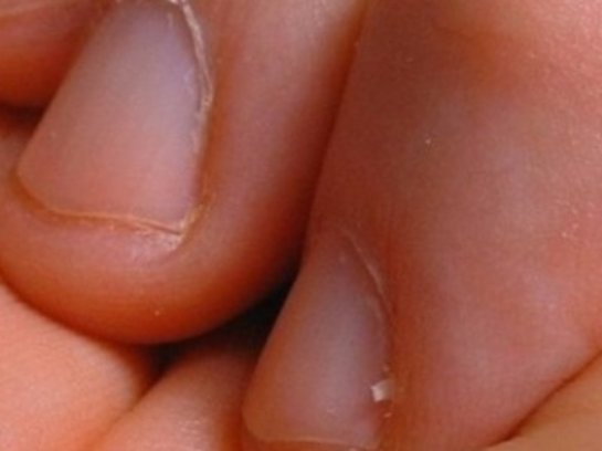 Почему появляются заусенцы на пальцах? как лечить
