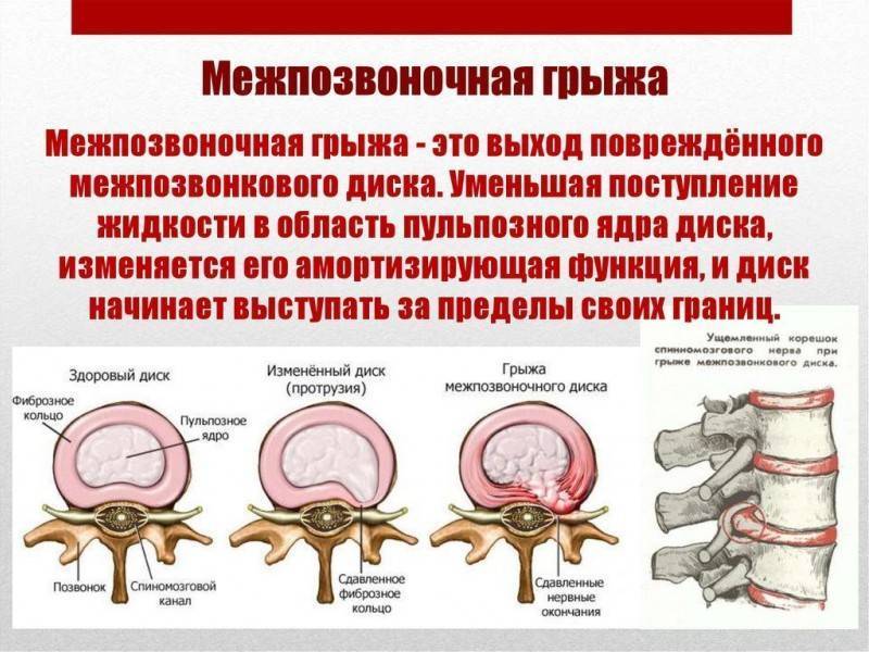 Протрузия дисков позвоночника фото