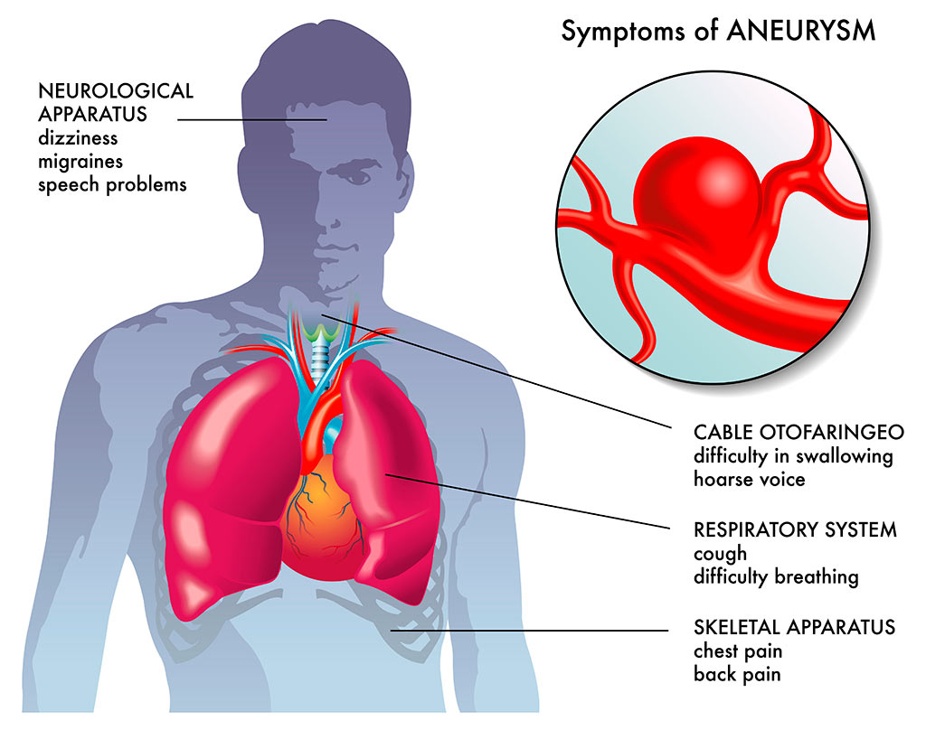 Аневризма аорты сердца: причины, симптомы и лечение