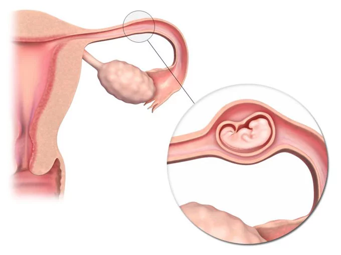 Беременность эктопическая (ectopic pregnancy), беременность внематочная (extrauterine pregnancy)