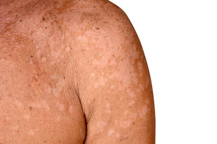 Грибковые заболевания кожи: фото, симптомы, названия видов микоза, методы лечения