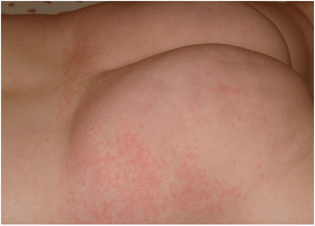 Сыпь на попе у ребенка 6 лет. появились высыпания от аллергии на попе у ребенка. лечение аллергической сыпи на попе у ребенка