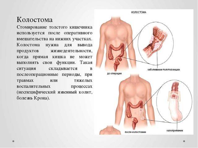 меню для стомированных людей. Смотреть фото меню для стомированных людей. Смотреть картинку меню для стомированных людей. Картинка про меню для стомированных людей. Фото меню для стомированных людей