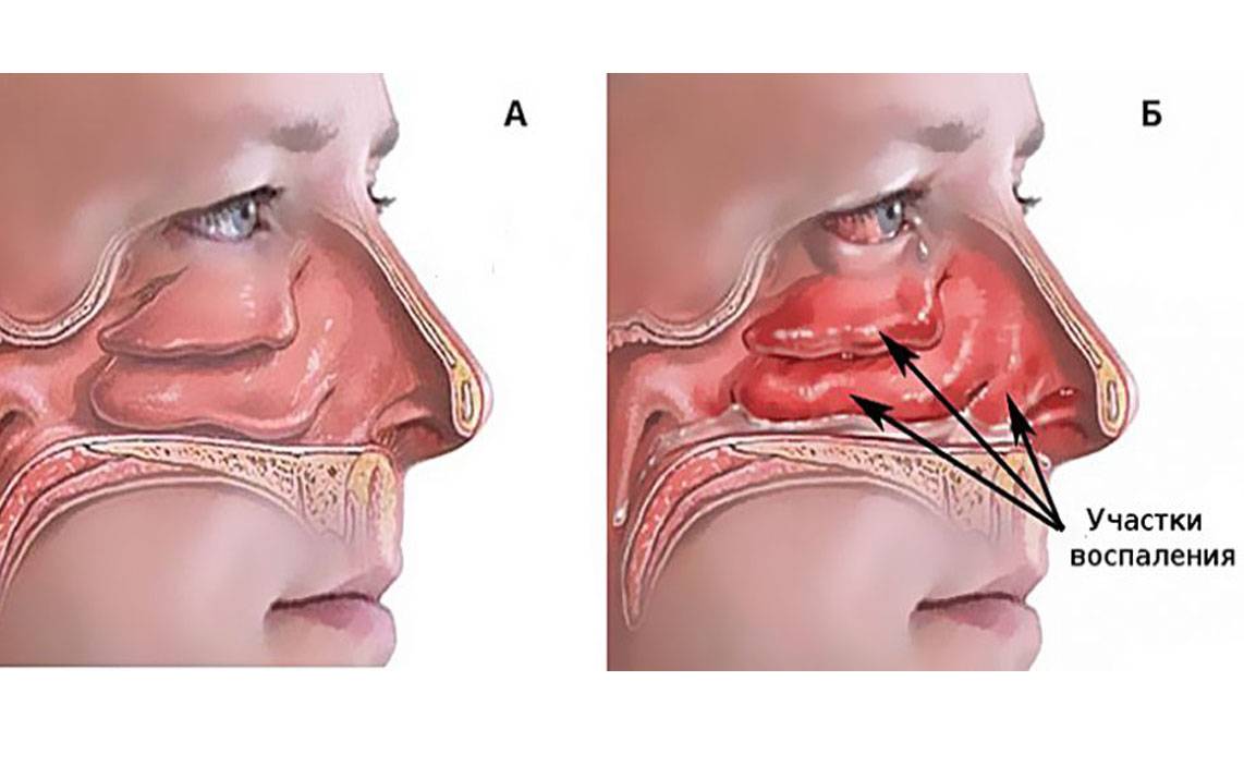 Хронический ринит презентация