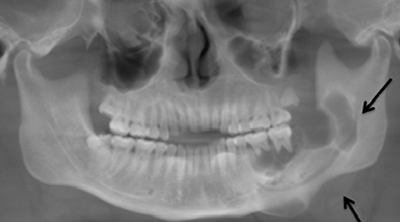 Остеомиелит челюсти, классификация, симптомы и лечение