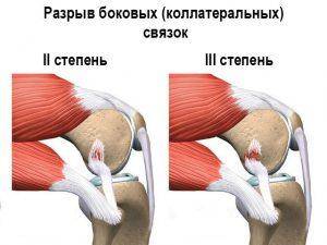 Растяжение связок коленного сустава: эффективное лечение