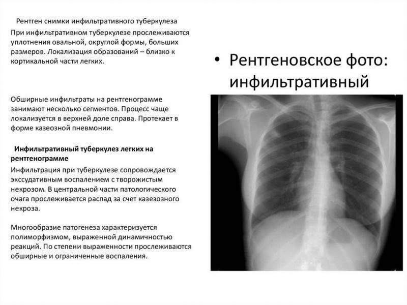 Симптомы, признаки, стадии и формы туберкулеза легких у взрослых