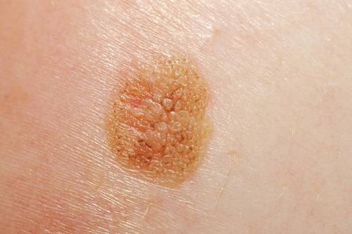 Меланома кожи – как выглядит рак кожи (фото)? меланома кожи – стадии по тнм, симптомы и признаки