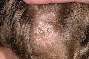 Лечение микроспории гладкой кожи