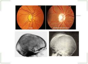 Лечение атрофии зрительного нерва народными средствами