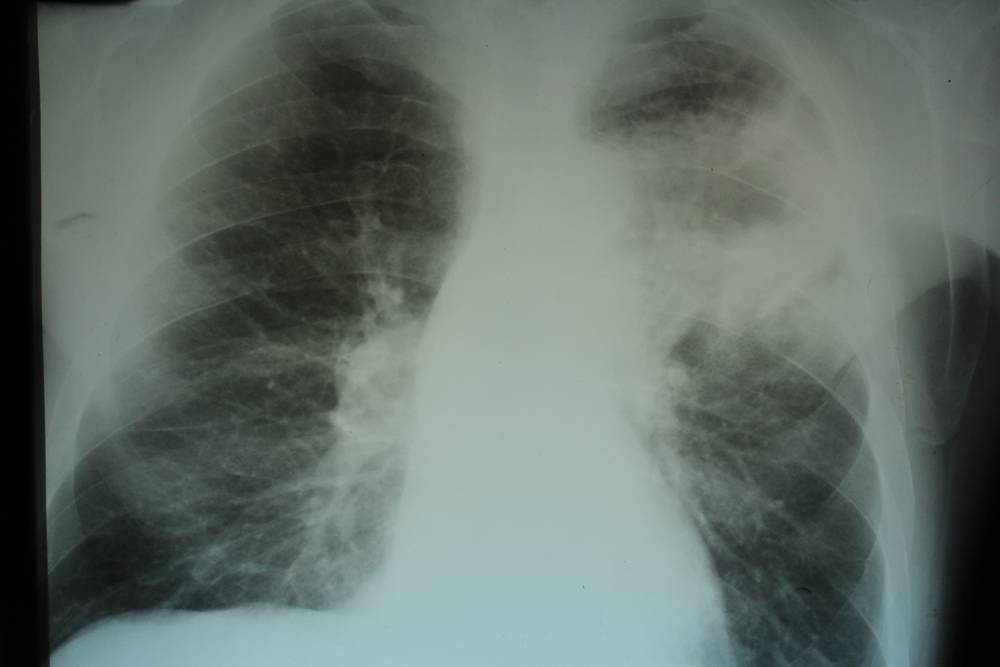 Диагностика туберкулеза при помощи рентгена