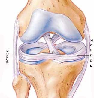Мениск колена: причины, симптомы повреждения и лечение