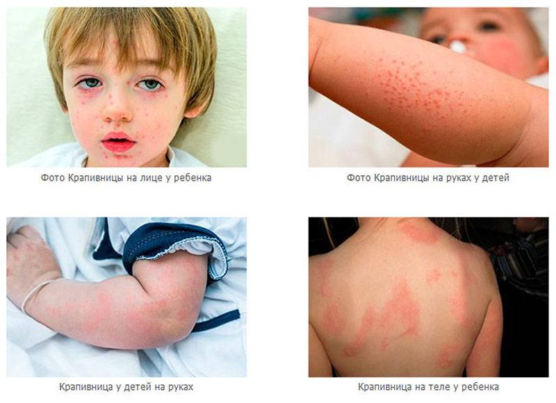 Как выглядит крапивница у ребёнка: причины появления, основные симптомы и неотложная помощь при внезапном развитии заболевания
