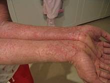 Мазь от мокнущей экземы — аллергия