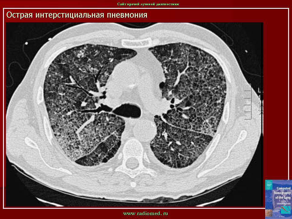 Картина интерстициальных изменений в легких кт что это