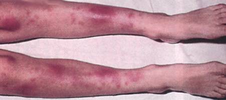 Узловатая эритема — заболевание, поражающее кожные и подкожные ткани