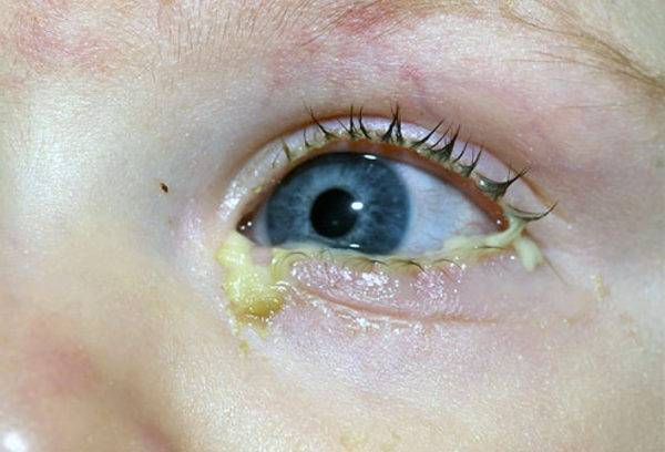 Аллергический конъюнктивит у детей: 7 основных причин и 5 способов лечения