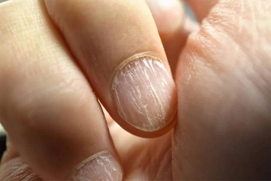 Что делать, если слоятся ногти на руках?