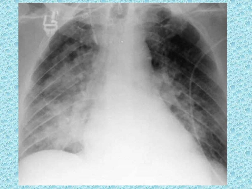 Снимок легких при пневмонии у ребенка фото