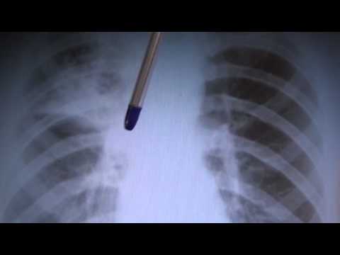 Чем отличается туберкулез от рака легких на снимках
