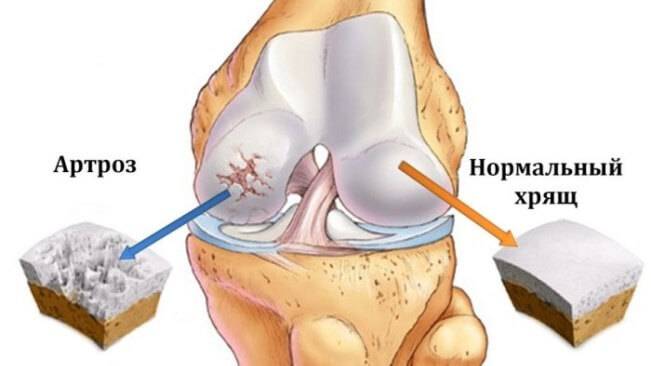 Повреждение менисков коленного сустава. механизм повреждения. клиника, диагностика, лечение.