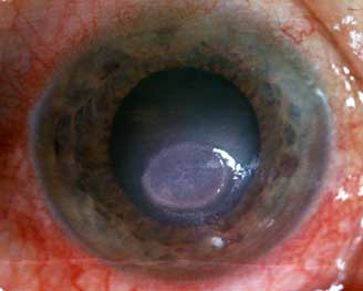 Кератит: симптомы и лечение, глаза, акантамебный, грибковый
