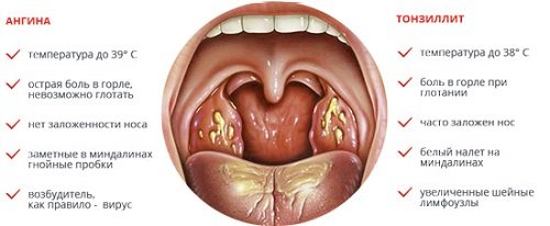 Миндалины в горле: воспаление. фото. симптомы и лечение.