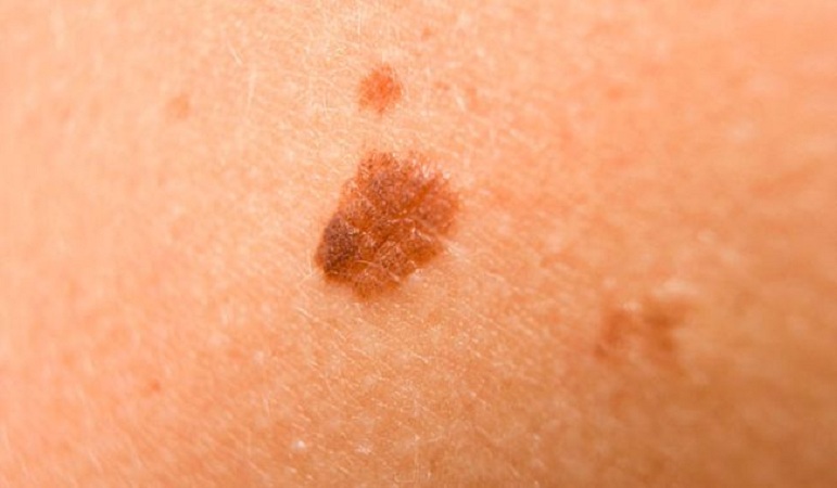 Меланома кожи – как своевременно распознать рак?