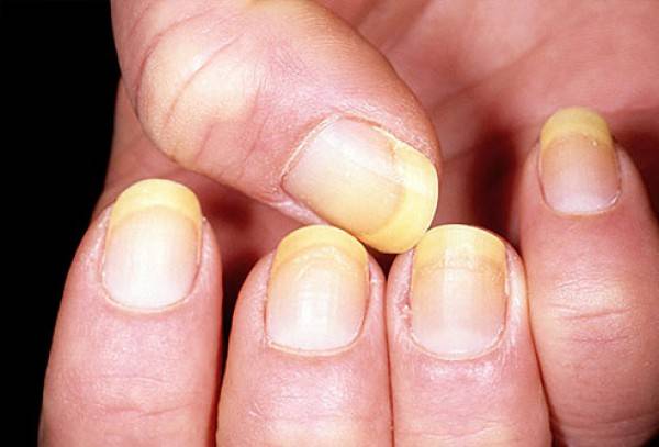 Продольные полосы на ногтях рук. причины, фото и лечение у детей и взрослых