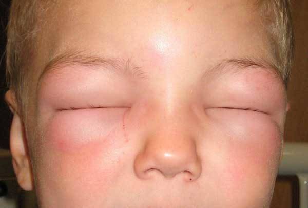 Аллергия на веках