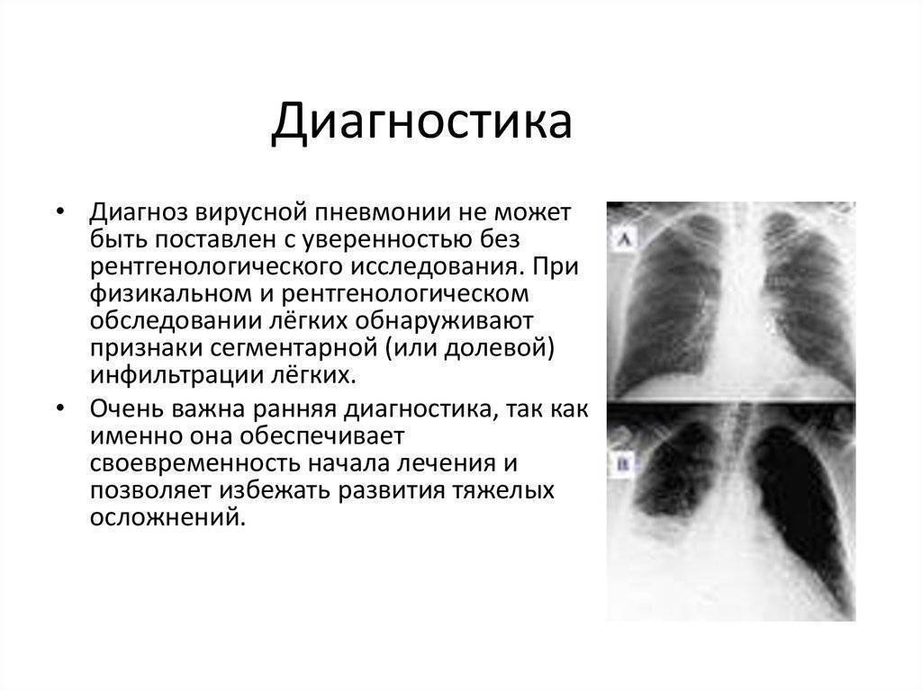 Чем отличается пневмония от ковида 19. Лихорадочный синдром пневмония. Диагноз воспаление легких.