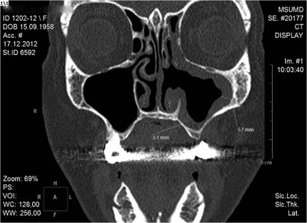 Одонтогенный синусит верхнечелюстной пазухи. Острый Гнойный одонтогенный синусит мкб. Одонтогенный синусит кт.