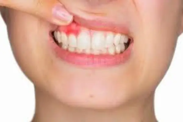 Остеомиелит челюсти (острый и хронический), симптомы и лечение