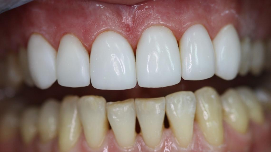 Восстанавливается ли эмаль зубов