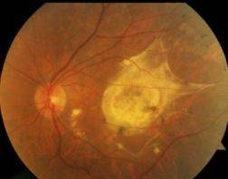 Макулодистрофия сетчатки глаза - лечение. причины ее, типы и симптомы