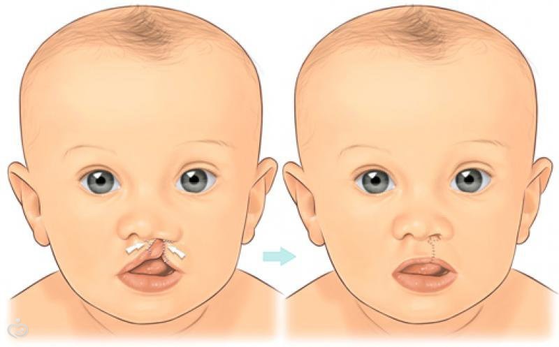 Заячья губа и волчья пасть: фото детей до и после операции