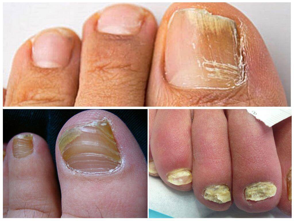 Белые пятна, гребни, утолщения: о каких скрытых болезнях могут рассказать наши ногти?