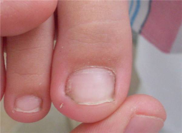 Мази для лечения вросшего ногтя