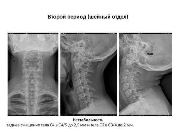 Искривление шейного отдела фото