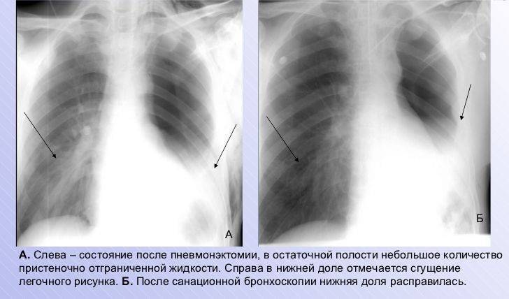 Затемнение нижних легких. Затемнение в лёгких на рентгене. Затемнение на рентгене легких. Снимок легких флюорография. Структуры на снимке легких.