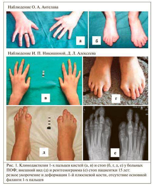 Лишняя кость. Фибродисплазия оссифицирующая прогрессирующая. Фибродисплазия симптомы. Миозит оссифицирующий прогрессирующий. Клинодактилия пальцев ног.
