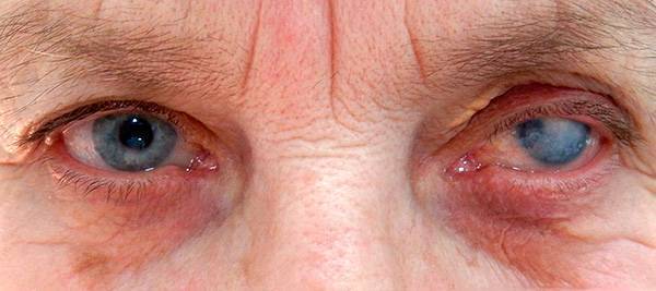 Воспаление глаза роговицы: причины, симптомы, лечение