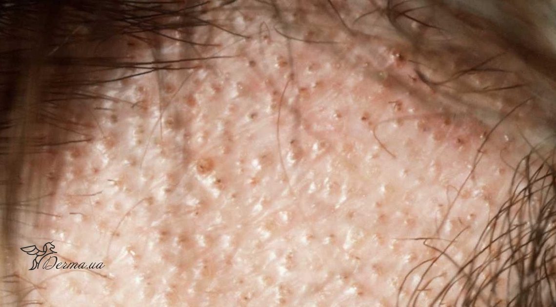 Микроспория гладкой кожи: симптомы, признаки и лечение